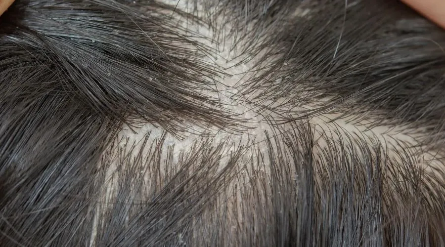Many things can cause a dry scalp