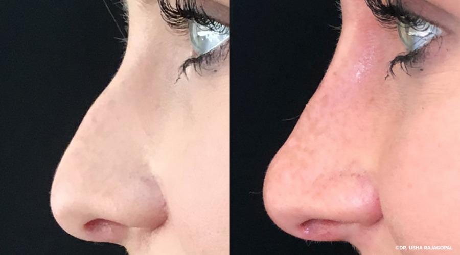 Surgical Nose Reduction